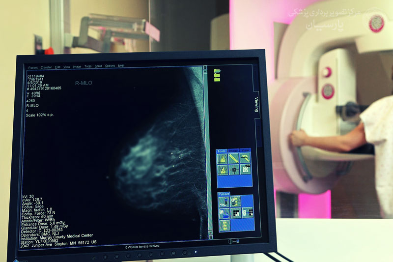 ماموگرافی دیجیتال